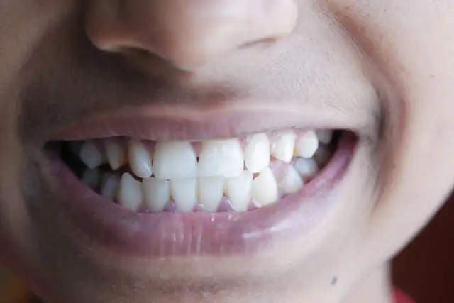 teeth — photo